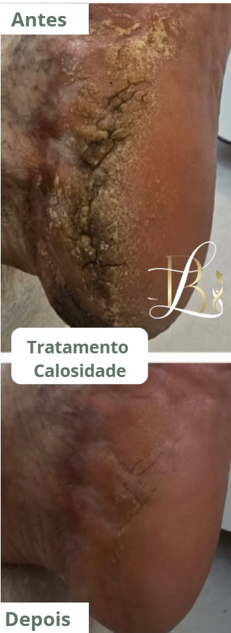 Calosidade.jpg