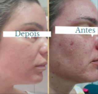 Acne.jpg