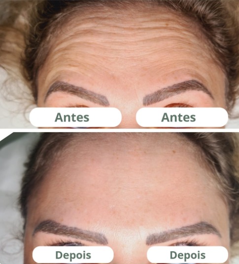 botox.jpg
