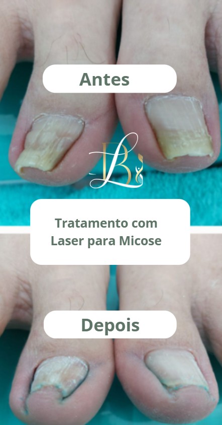 Micose Laser.jpg